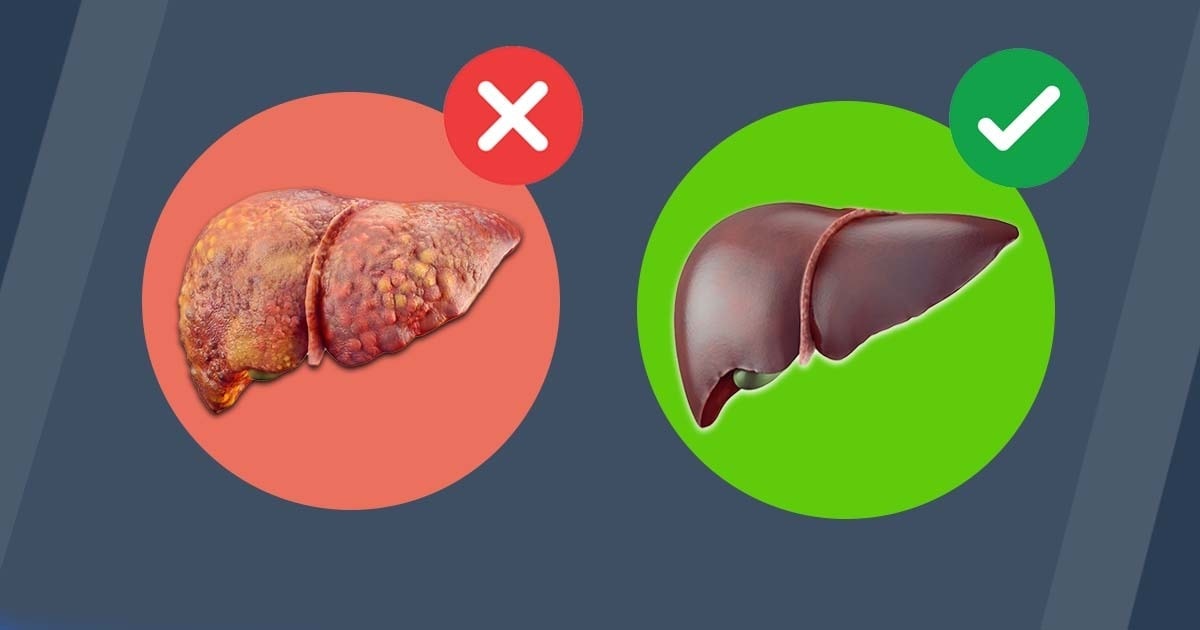 Májtisztítás – így szabadulj meg a has körül lerakódott zsírtól